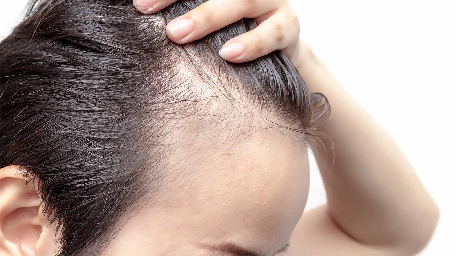 Receding hairline Strip