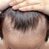 Front Hairline Strip